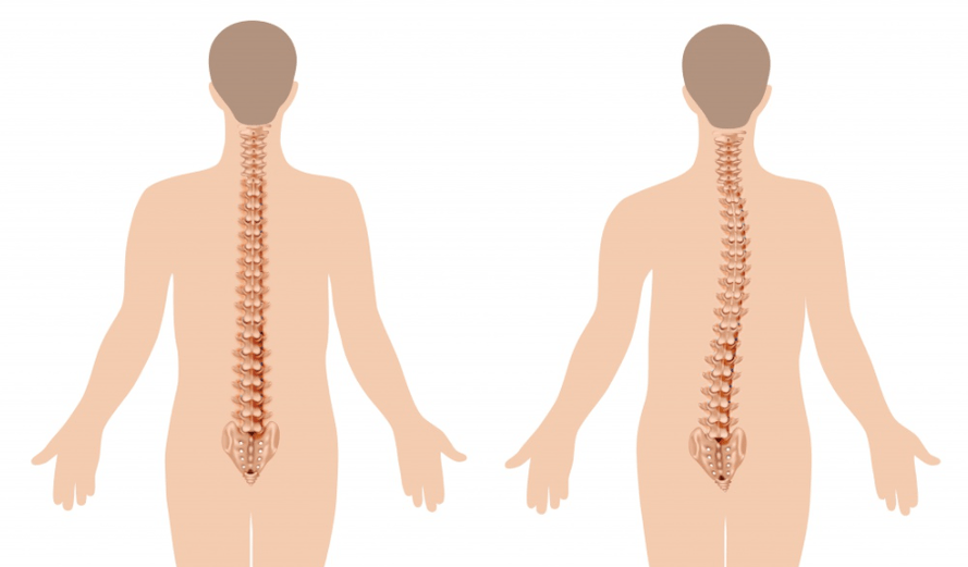 osteochondrozės pasireiškimas